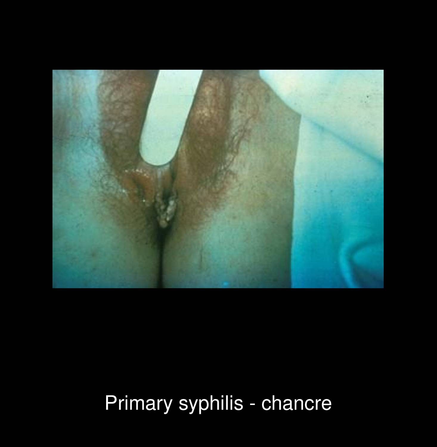 Condyloma lata in secondary syphilis showing moist flat-topped papular lesions in perianal region highly infectious with abundant Treponema pallidum